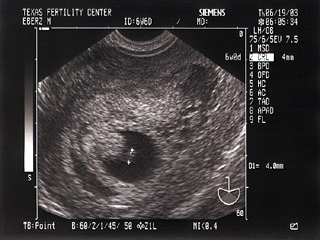 Mojo's Fetus 2